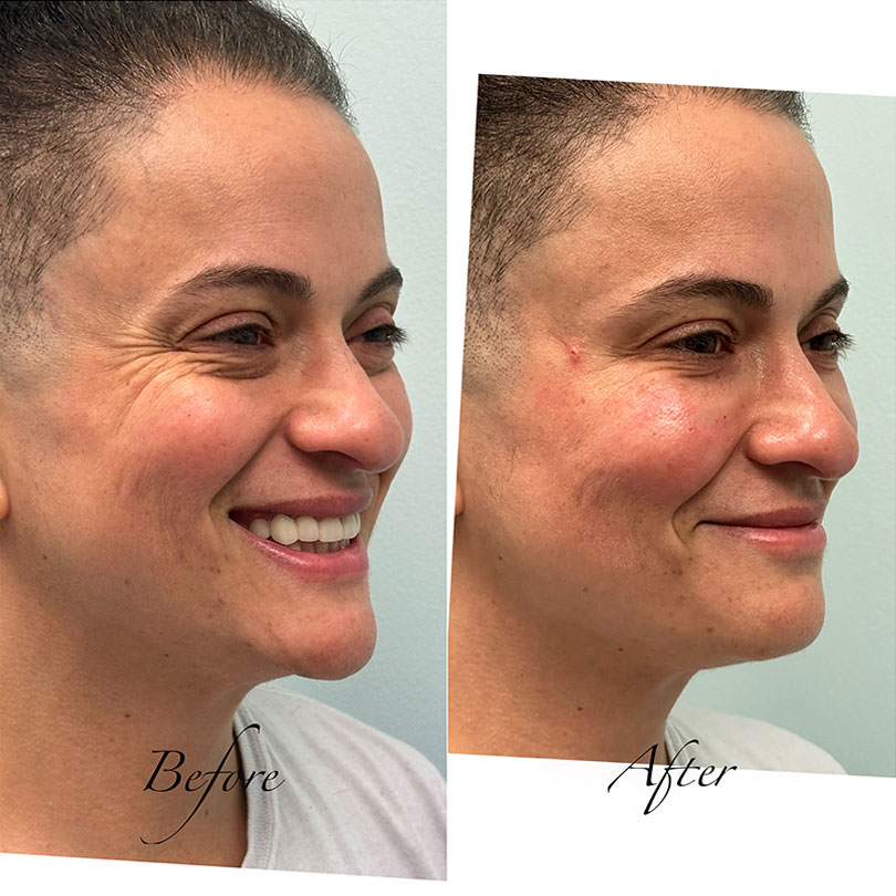 Benefits of Derma Gel PRP in Fort Lauderdale