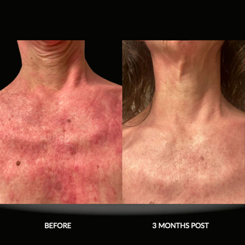 benefits of exosome facial rejuvenation fort lauderdale