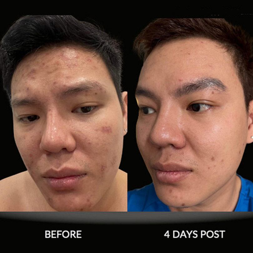 exosome facial rejuvenation fort lauderdale