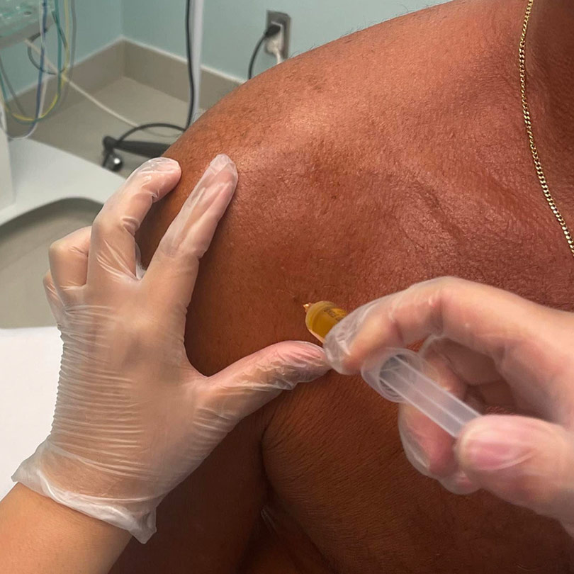 prp injections fort lauderdale