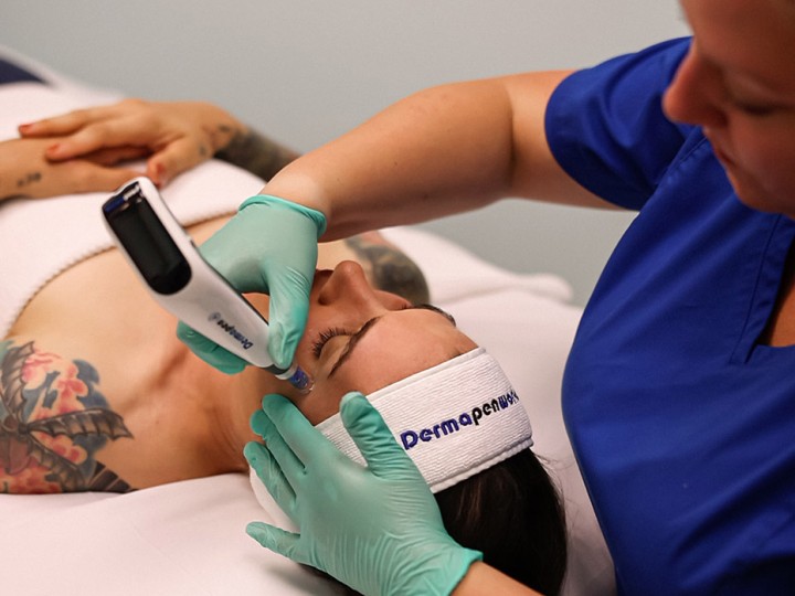 microneedling-treatment-222