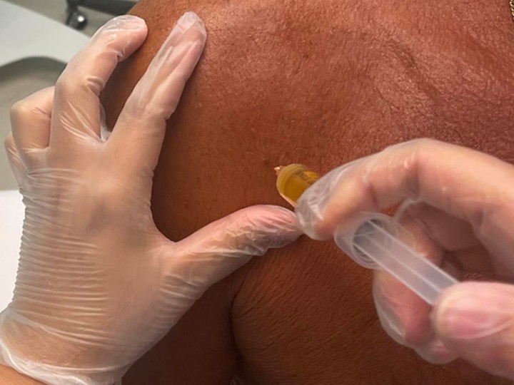 prp joint injections fort lauderdale