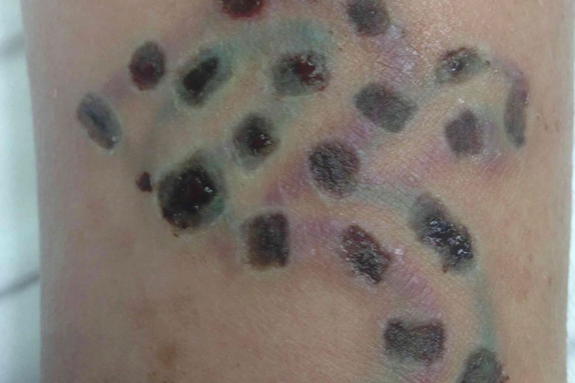Disappearing Ink New Tattoo Removal Method  SPACLINIC